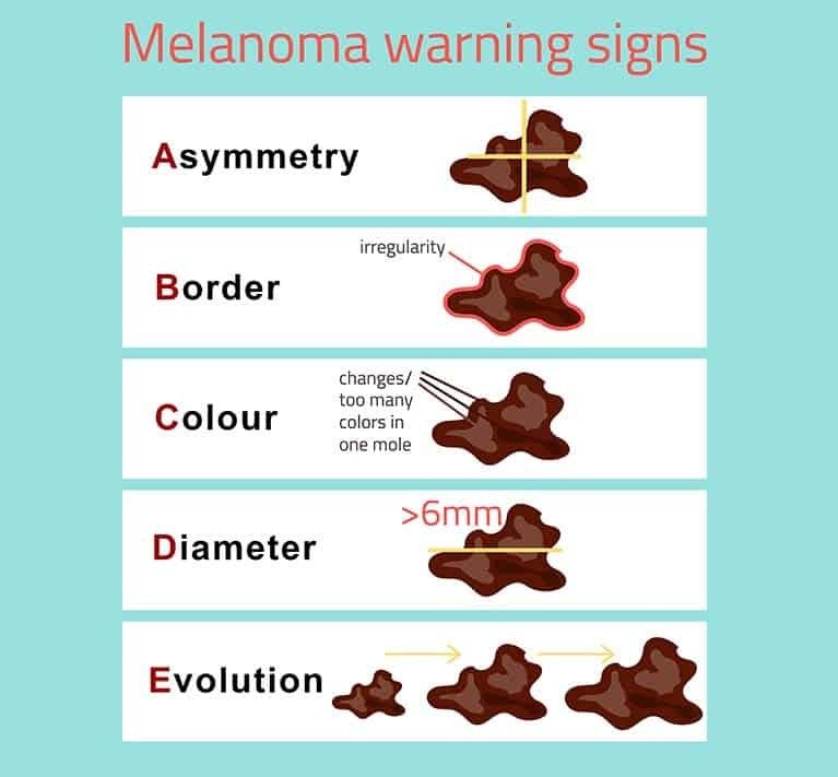 A Simple Guide to Identifying Early Signs of Skin Cancer: Checking Your Skin