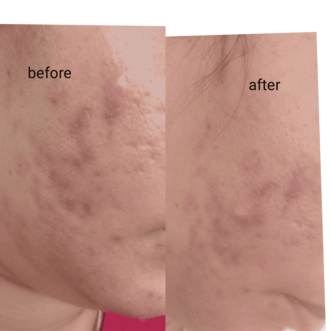 Understanding Acne: Causes, Development, and Variations