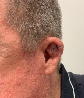 Wedge resection performed on the ear