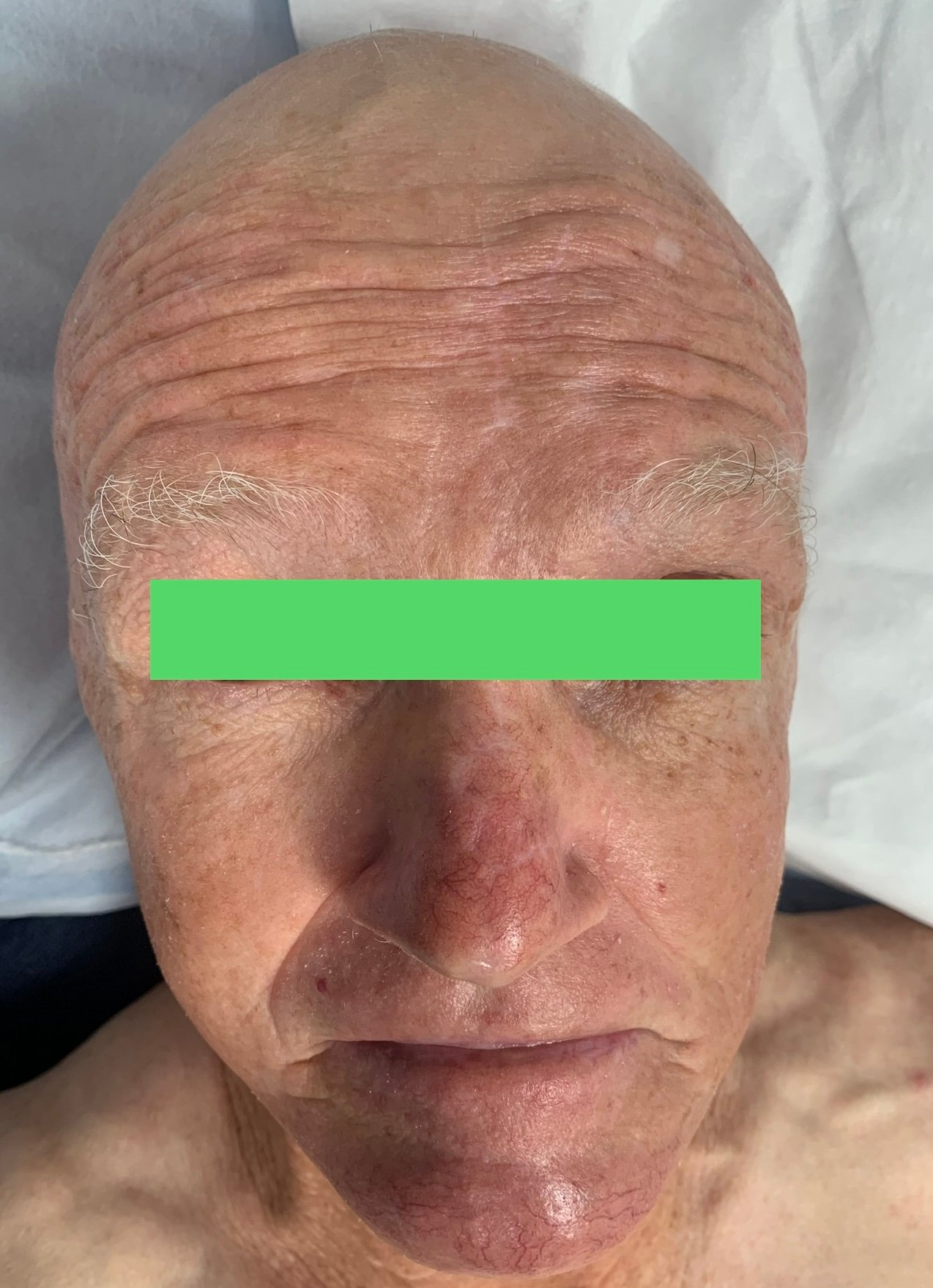 Elliptical excision performed on the forehead