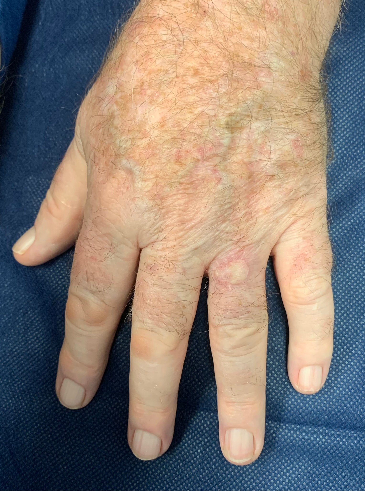 Full-thickness skin graft performed on the ring finger